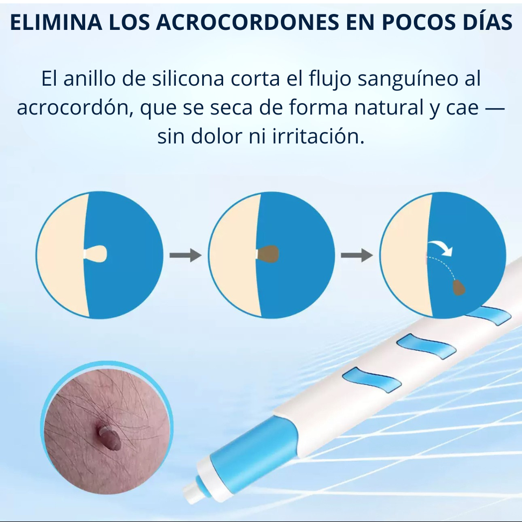 Dermaclare™ – ¡Adiós a los acrocordones! - kevana