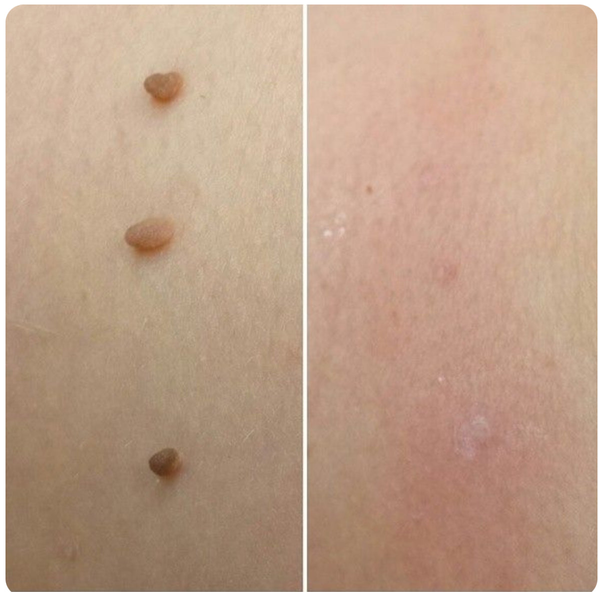 Dermaclare™ – Pelle libera, senza chirurgia - kevana