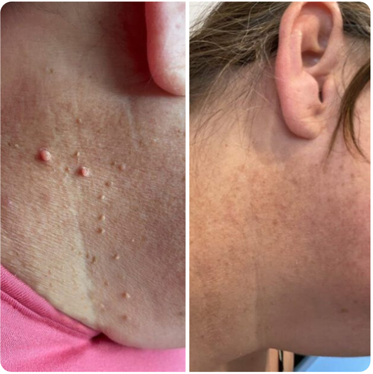Dermaclare™ – Pelle libera, senza chirurgia - kevana