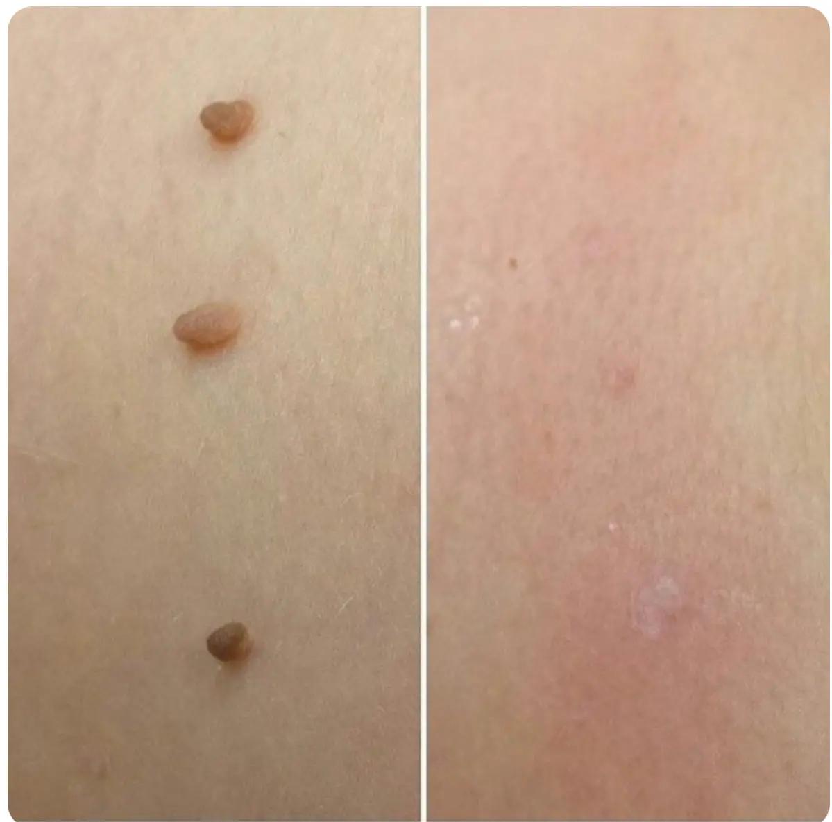 FibroPlus™ –  Addio alle escrescenze cutanee - kevana 