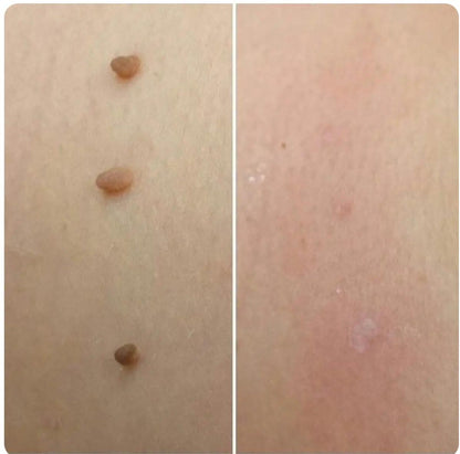 FibroPlus™ –  Addio alle escrescenze cutanee - kevana 