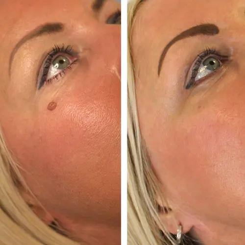 FibroPlus™ –  Addio alle escrescenze cutanee - kevana 