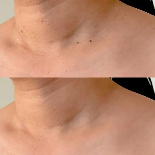 FibroPlus™ –  Addio alle escrescenze cutanee - kevana 