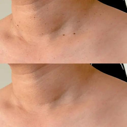 FibroPlus™ –  Addio alle escrescenze cutanee - kevana 