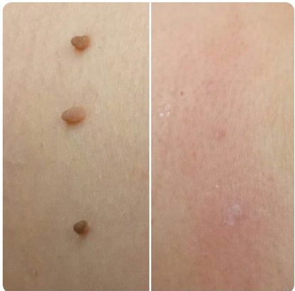 Dermaclare™ – Pelle libera, senza chirurgia - kevana 