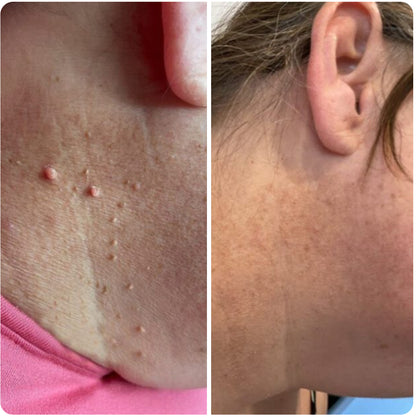 Dermaclare™ – Pelle libera, senza chirurgia - kevana 