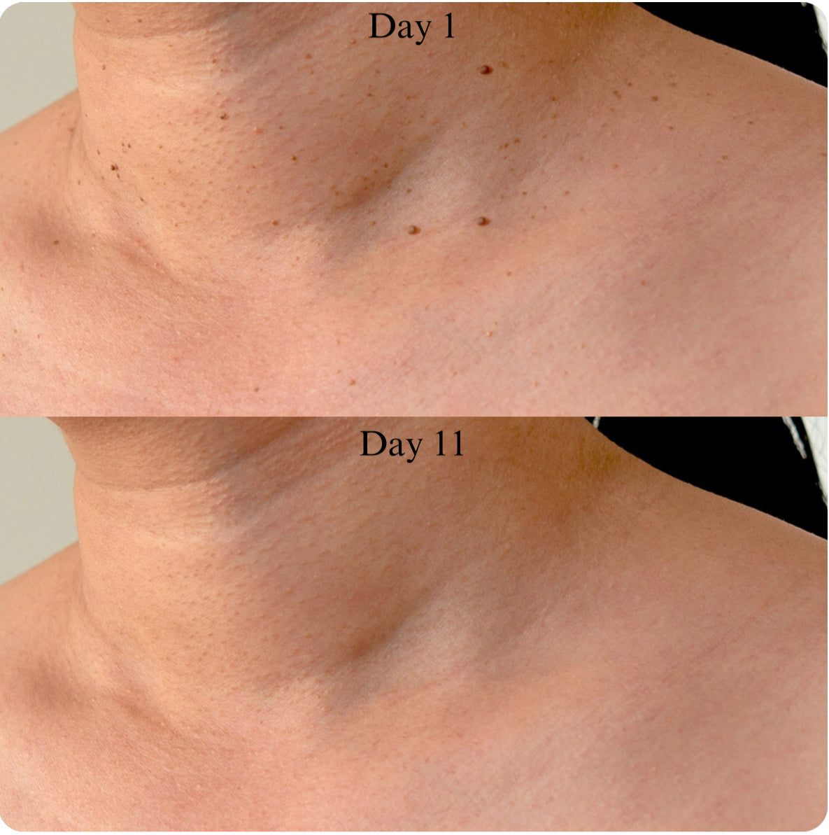 Dermaclare™ – Pelle libera, senza chirurgia - kevana 