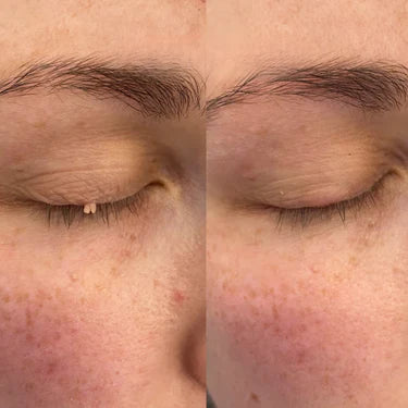 Dermaclear™ – Adiós, lunares y verrugas cutáneas